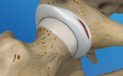 What is a Hip Labral Tear?